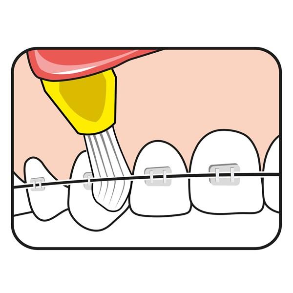 Cepillo TePe Interspace para ortodoncias